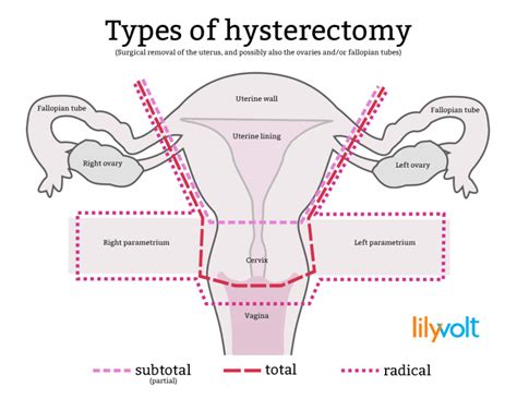 So What Is A Hysterectomy Anyway Lilyvolt