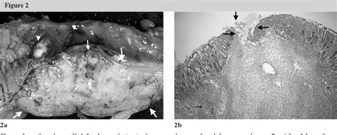 Figure 2 from Amoebic Colitis in an Acquired Immune Deficiency Syndrome ...