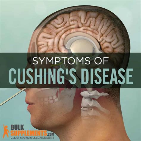 Cushing's Disease: Symptoms, Causes & Treatment