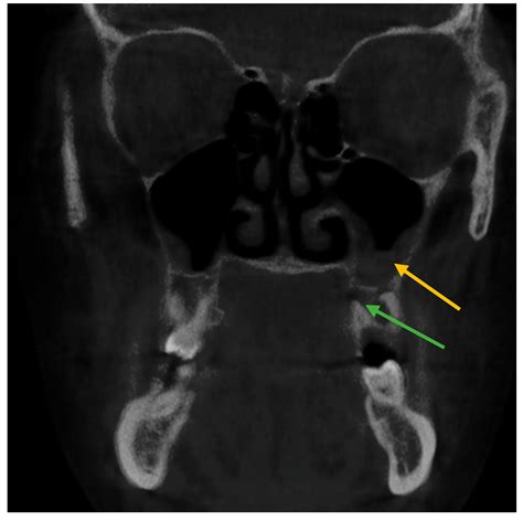 Healthcare Free Full Text Cbct Evaluation Of Periapical Pathologies