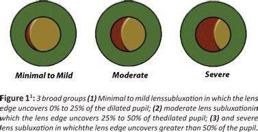Lens Subluxation &... - Ophthalmology-Notes And Synopses