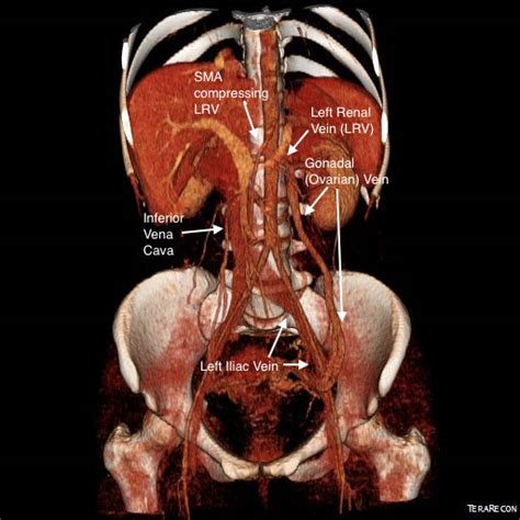 gonadal vein transposition – A Surgeon's Notes