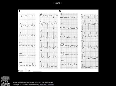 Heartrhythm Case Reports Ppt Download