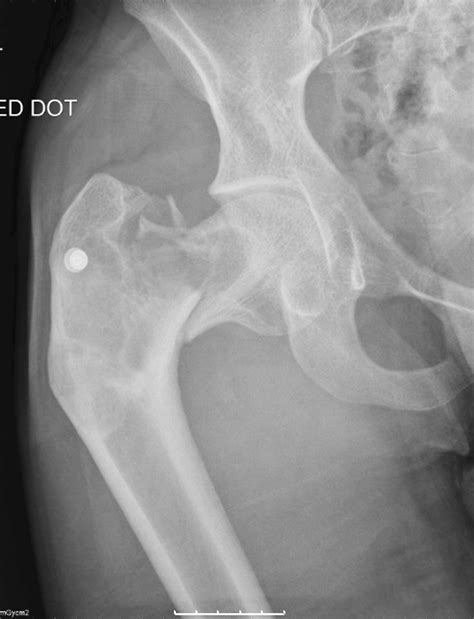 Antero Posterior Radiograph Of The Right Hip Showing A Shepherds Crook