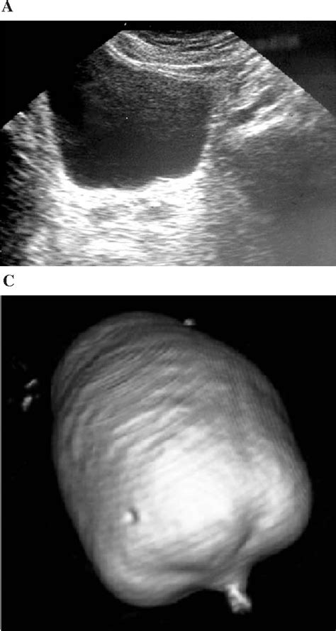 Figure From Comparison Of Virtual Cystoscopy And Transabdominal