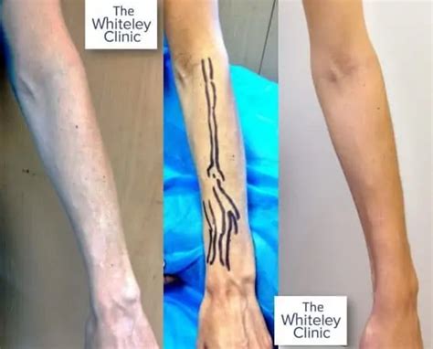 Arm Veins Removal Treatment