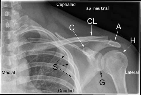 Posterior Shoulder Dislocation Mechanism