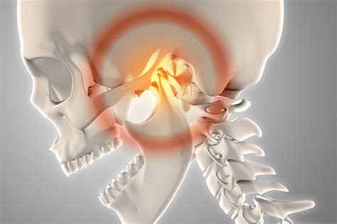 Trastorno De La Articulaci N Temporomandibular Atm Cl Nica Dental