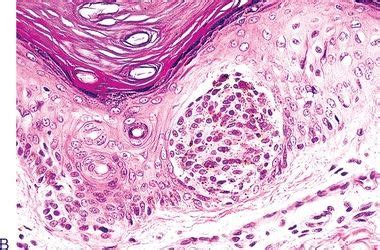 Melanocytic Lesions | Basicmedical Key