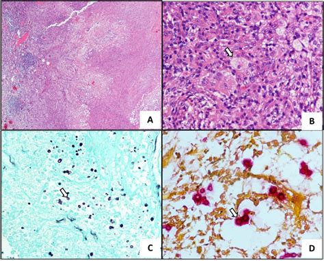 Pulmonary Cryptococcosis Presenting With Lung Mass Report Of 7 Cases And Review Of Literature