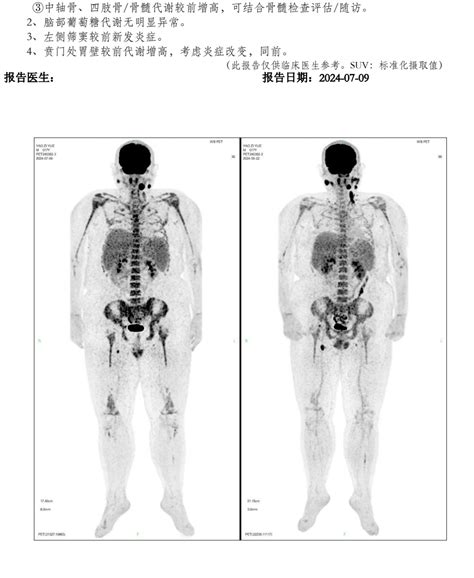 戈利昔替尼胶囊有人了解或者用过这个靶向药吗 淋巴瘤之家