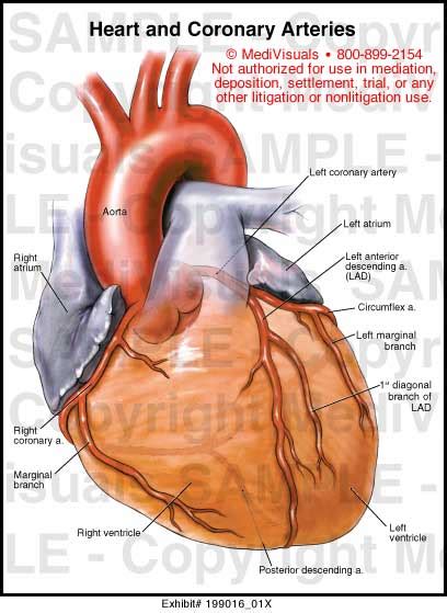 Heart And Coronary Arteries Medical Exhibit Medivisuals