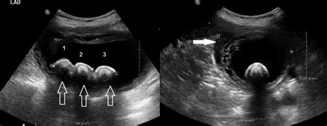 Gallbladder Torsion With Acute Cholecystitis And Gross Necrosis Bmj Case Reports