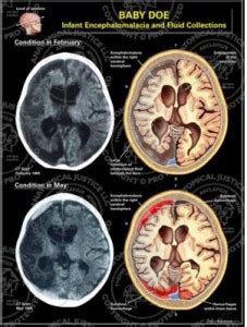 Encephalomalacia Symptoms, Definition, Prognosis, Treatment