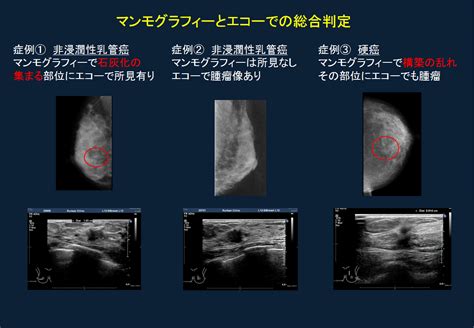 乳がん健診を識る｜ひふみクリニック 埼玉県川口市東領家の内科乳腺外科外科皮膚科総合診断