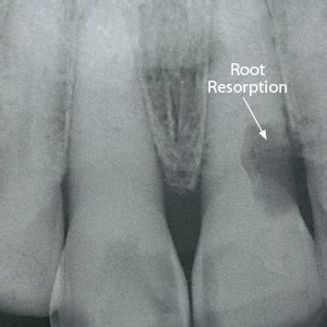 Early Action Needed to Save Your Tooth from Root Resorption