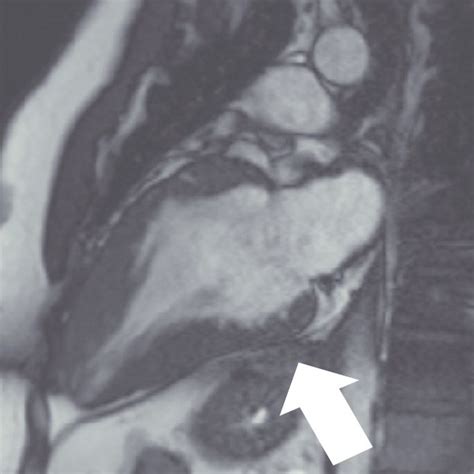 Basal Lateral Mid Wall Lge In Fabry Disease The Differential For This Download Scientific