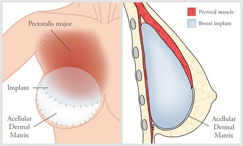 Understanding Capsular Contracture Causes And Treatment Options