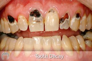 Tooth Decay Advice