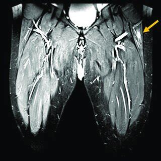 T Weighted Magnetic Resonance Imaging Mri With Contrast For Both