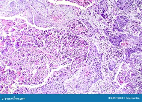 Carcinoma De C Lulas Escamosas De La Micrograf A De La Luz Pulmonar