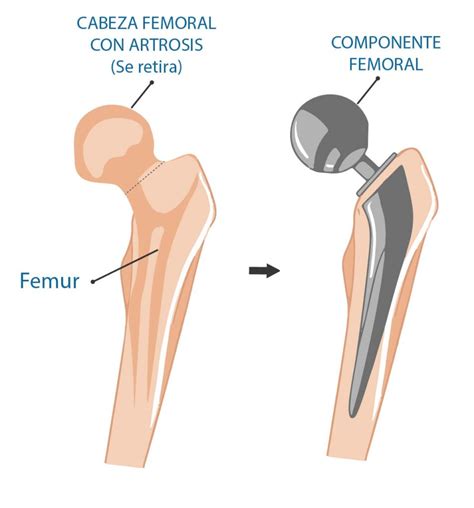 Cirug A Protesis Cadera Artrosis De Cadera Lima Per