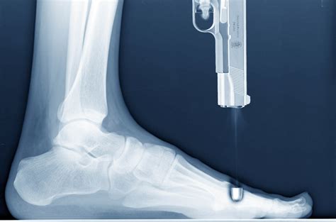 X Ray Shooting Self In Foot | MyConfinedSpace