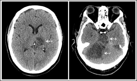 Basilar Artery Thrombosis During Sexual Intercourse Journal Of