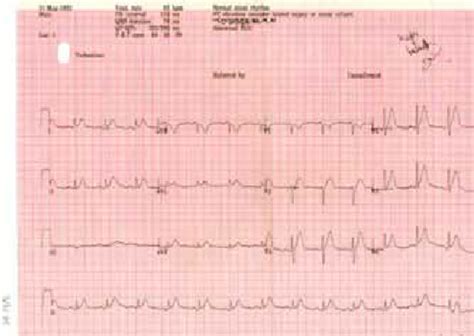 12 Lead Electrocardiogram Demonstrating Antero Lateral St Segment