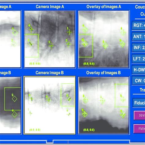 Six Dimensional Fiducial Tracking For Spinal Radiosurgery With The