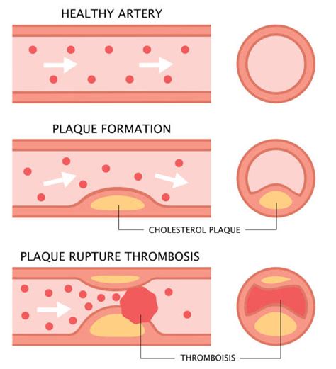 Plaque Arteries Illustrations Royalty Free Vector Graphics And Clip Art