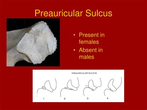 Preauricular Sulcus