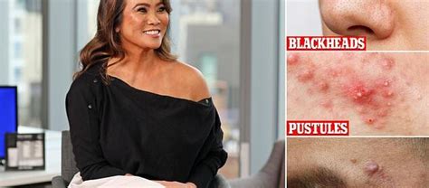 Dr Pimple Popper reveals EVERYTHING about zits, cysts, and blackheads ...