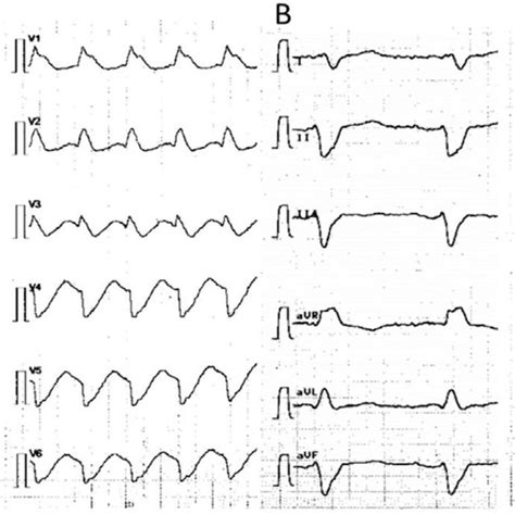 A 12 Lead Ecg Recorded During Tachycardia 50 Mm S Note The Absence Download Scientific