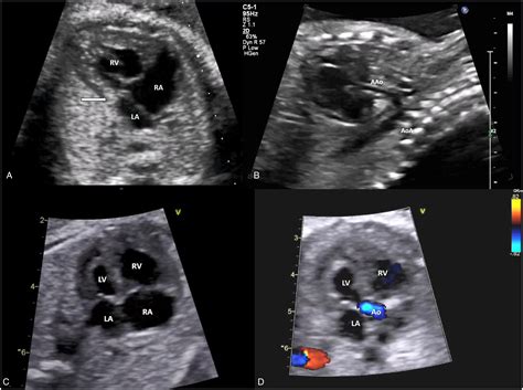 Imaging For Hypoplastic Left Heart Syndrome Simone R F Fontes Pedra 2022