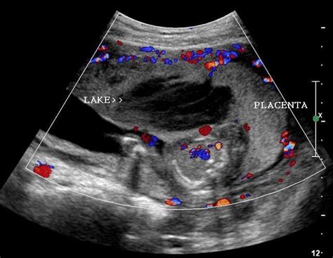 Normal Placenta Ultrasound