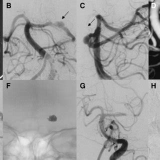 (A) A 16-year-old woman was detected of subarachnoid hemorrhage in CT... | Download Scientific ...