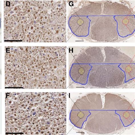 Focal Demyelination And Axonal Loss In The Spinal Cord Cortico Spinal