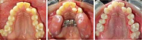 A Pretreatment Maxillary Occlusal View Showing Constricted Maxillary