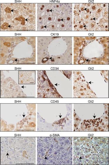 Hepatic Expression Of Sonic Hedgehog Induces Liver Fibrosis And