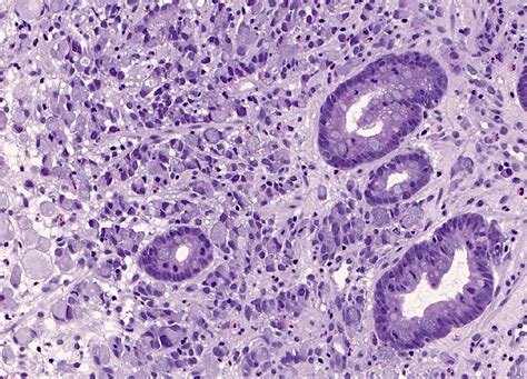 Pathology Outlines Carcinoma General