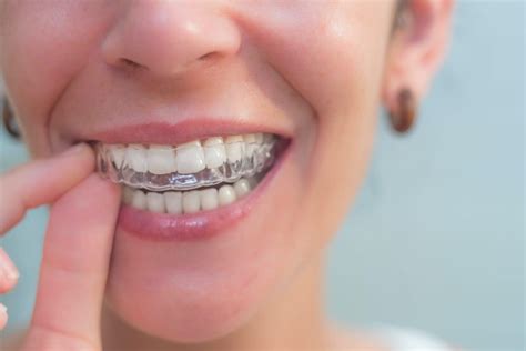 Invisalign Versus Braces In Chapel Hill Nc Dr Jim Furgurson