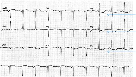 ECG changes with serum potassium of 2.0 mmol/L. | Download Scientific ...