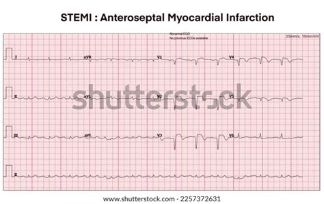 Electrocardiogram Show Anteroseptal Myocardial Infarctionstemiheart Beat Stock Illustration