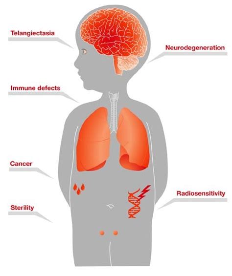 Ataxia telangiectasia; Louis-Bar Syndrome