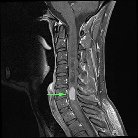 Spinal Tumours - Sydney Neurospine