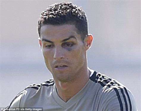 Cristiano Ronaldo: PICS Of Juventus Star Sporting BLACK EYE In Training ...