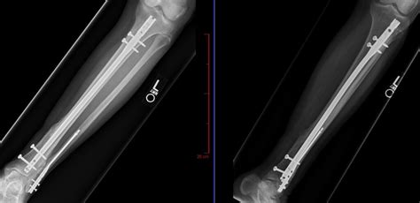 Minimally Invasive Tibia & Fibula Fracture Surgery San Jose | Ankle ...