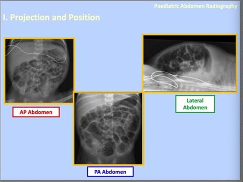 Paediatric Abdominal Imaging Flashcards Quizlet