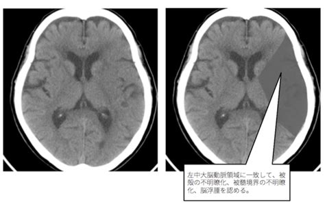 Ct Mri 脳 画像